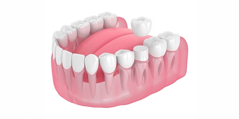 opcd - Cosmetic Dentistry - 3D Dental Crown