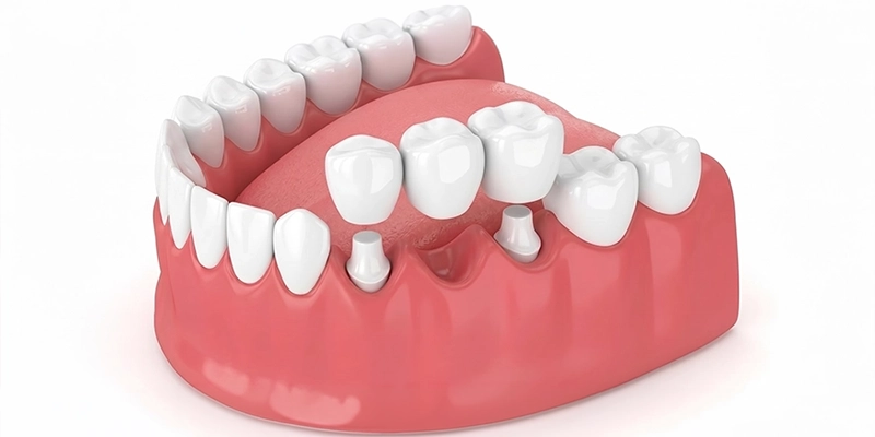 opcd - Cosmetic Dentistry - Dental Bridge