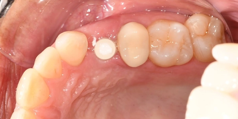 opcd - Cosmetic Dentistry - Dental Crown