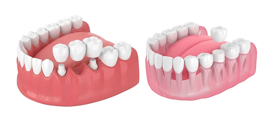 opcd - Dental Crown & Bridge Treatment