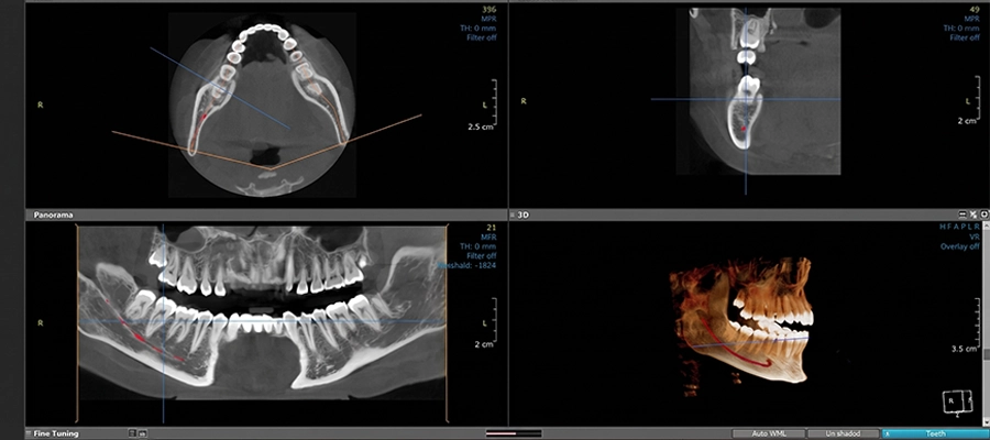 opcd - Digital implant planning software
