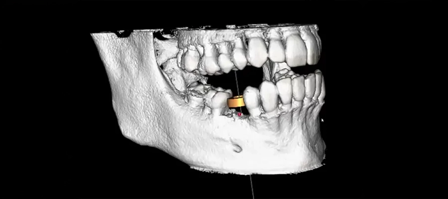 opcd - Jawbone Structure