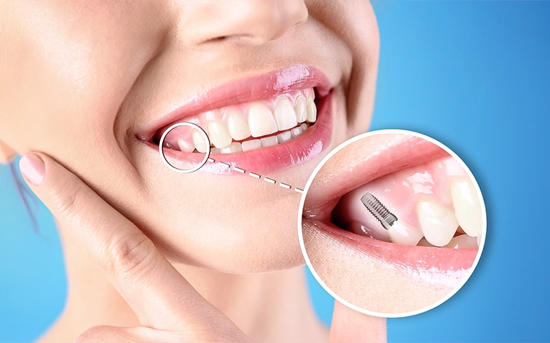 opcd - dental implants