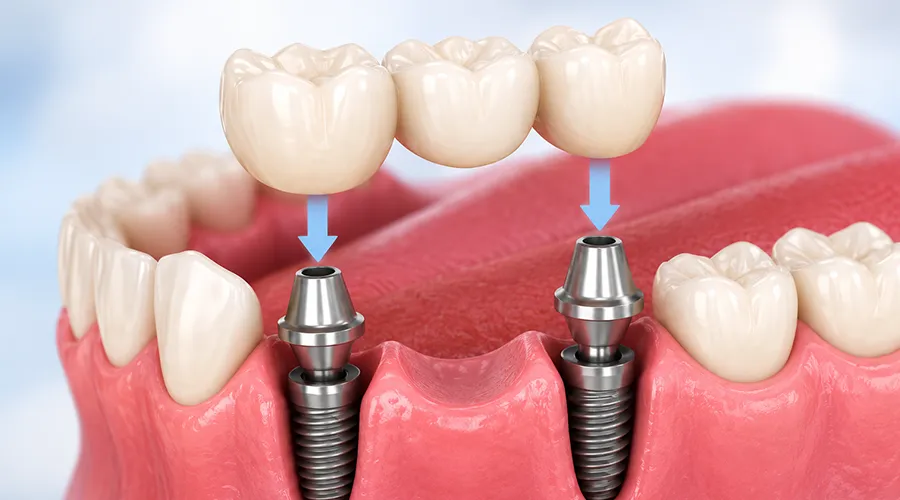Osborne Cosmetic dental - dental implants-02