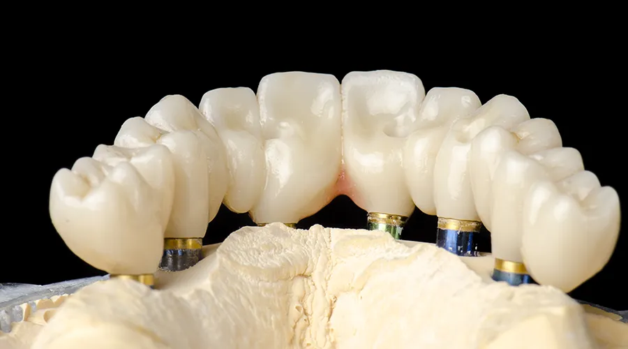 Osborne Cosmetic dental - dental implants-03