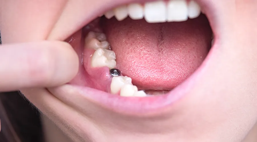 Osborne Cosmetic dental - dental implants