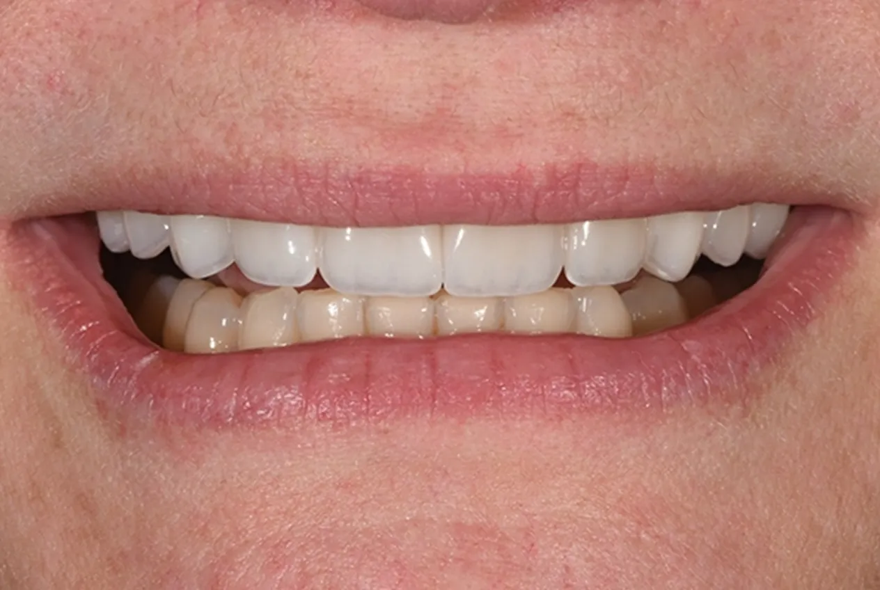 After Veneer
