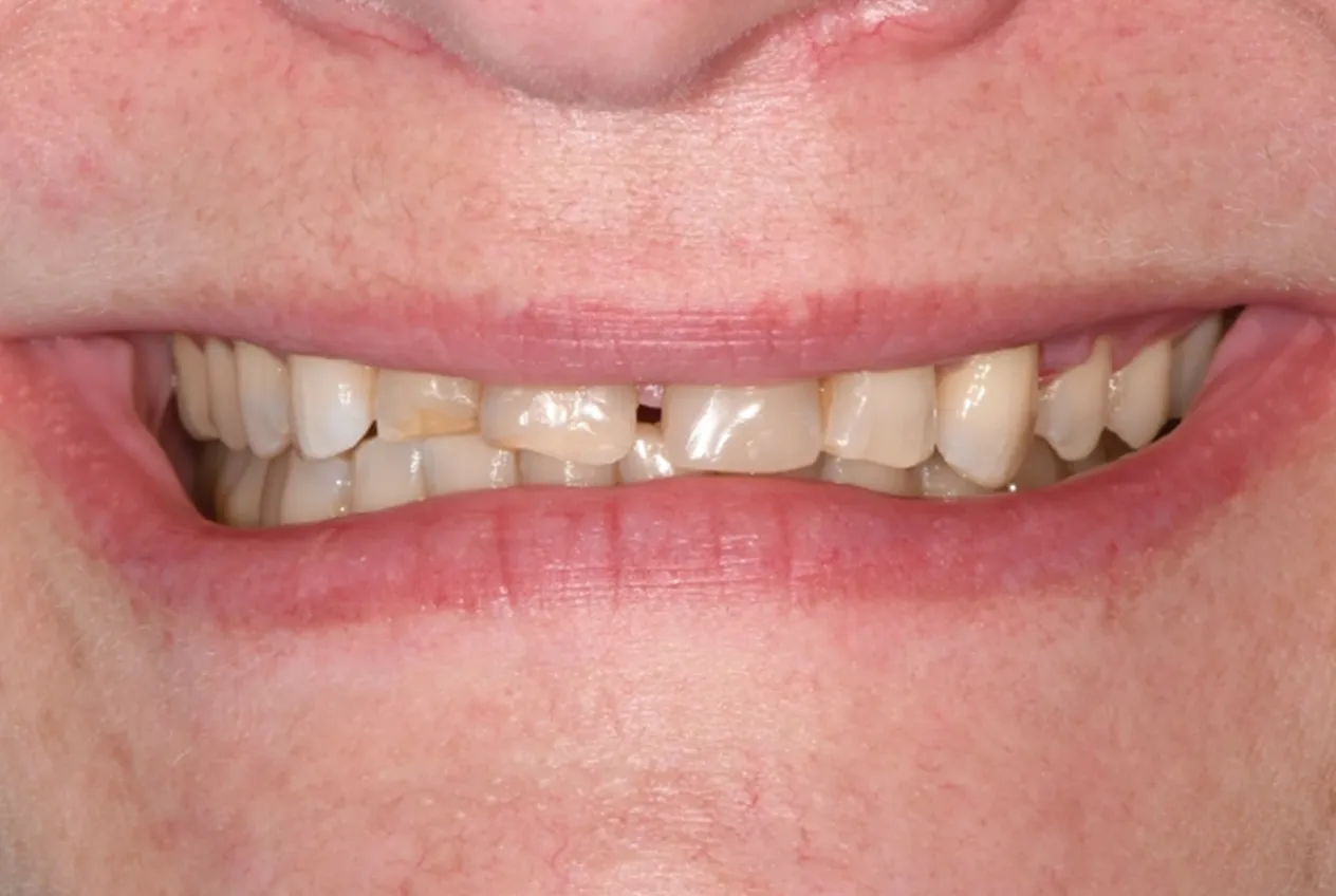 Before Veneer