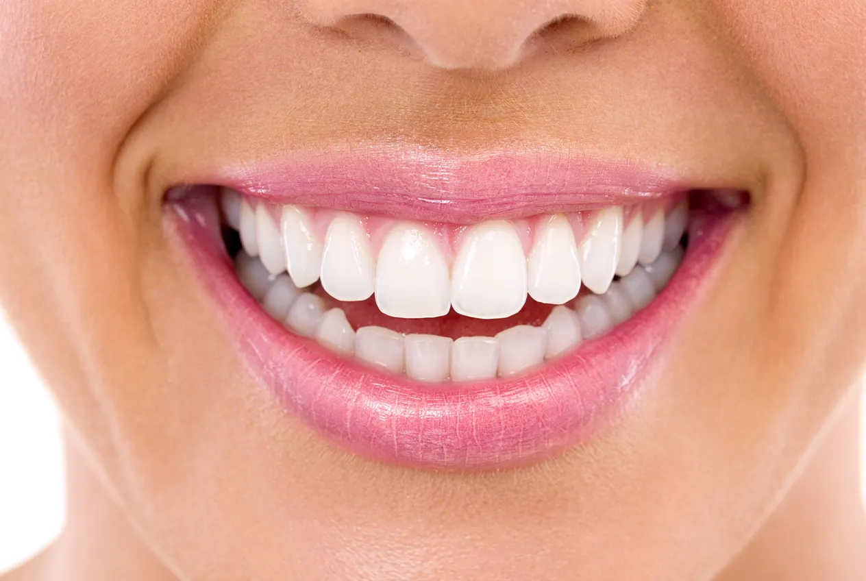 After Veneer