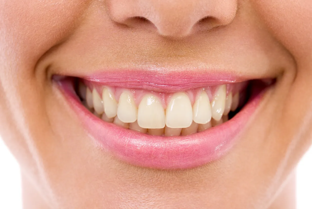 Before Veneer