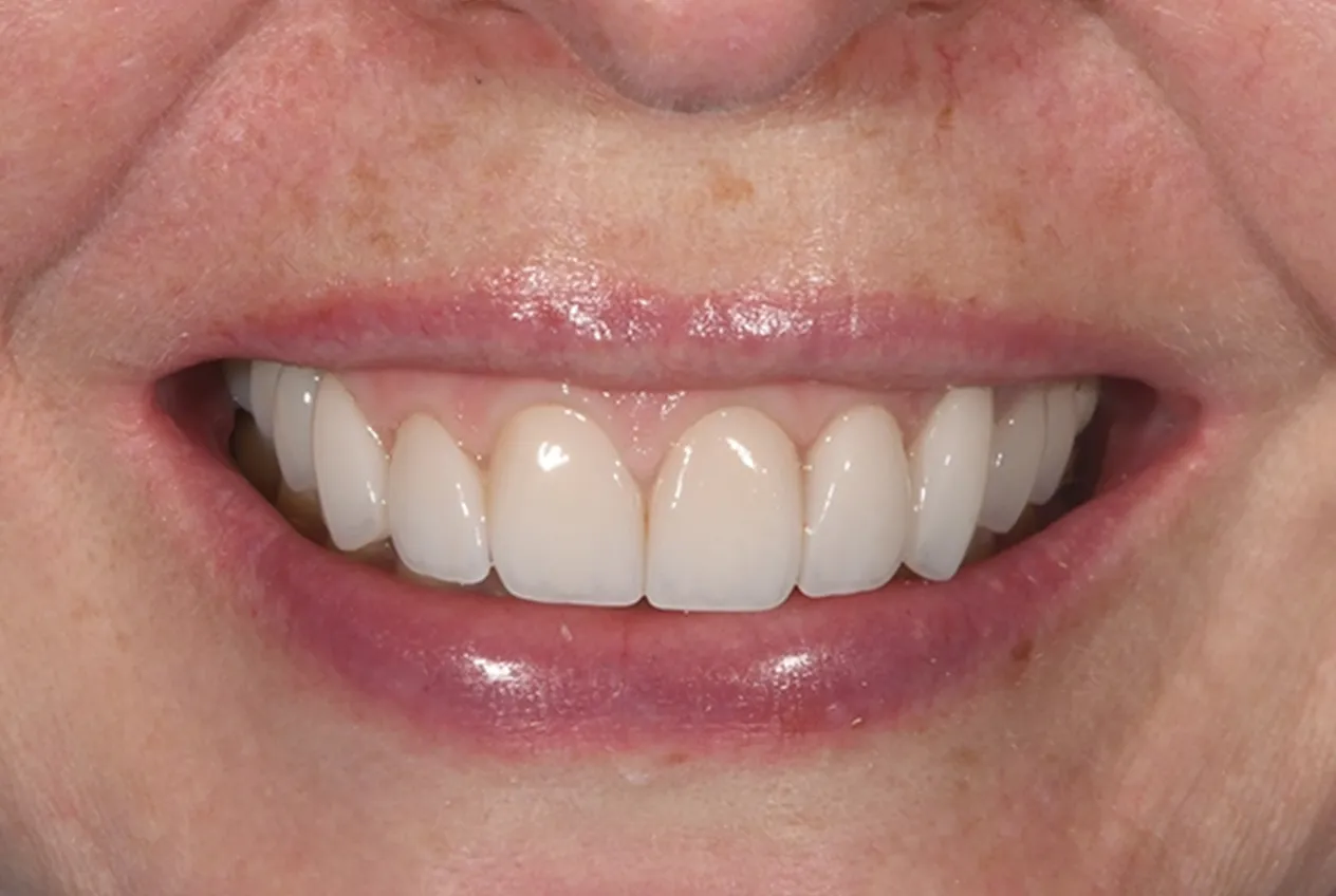 After Veneer