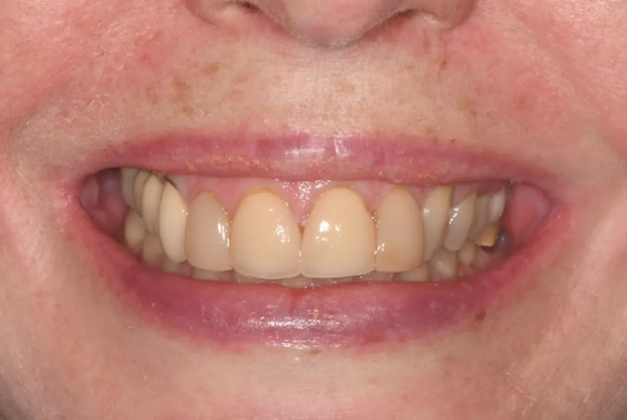 Before Veneer